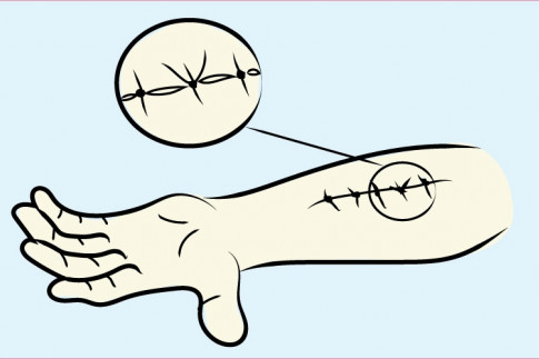 Flexor Tenosynovitis