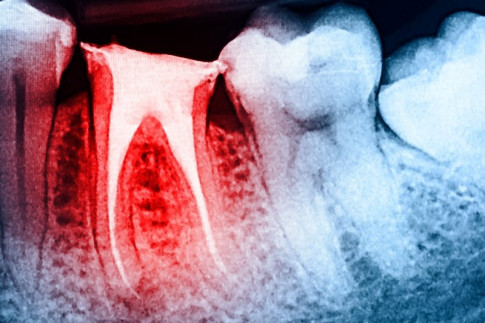 How Root Canals Could Severely Affect Your Health